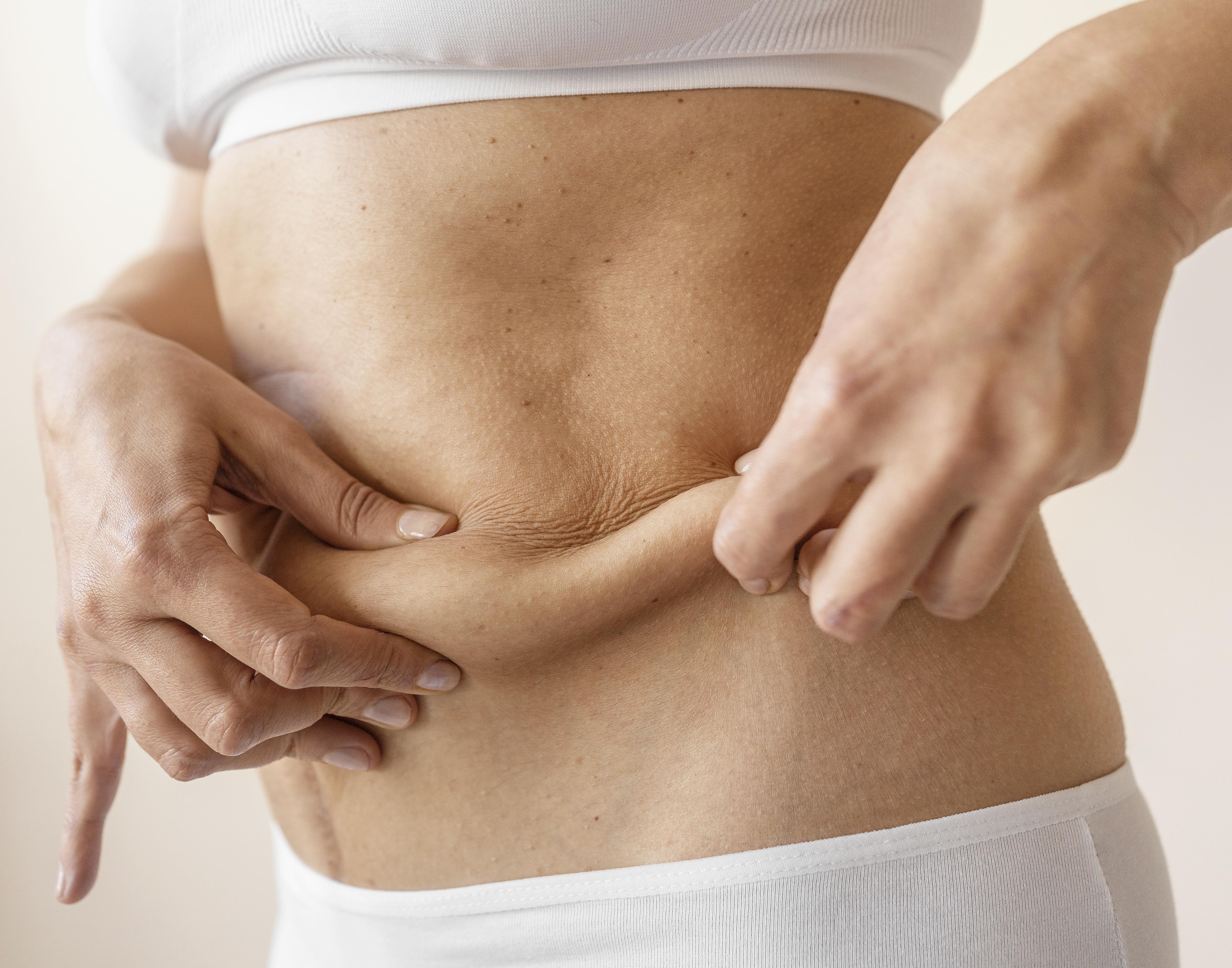 Liposuction