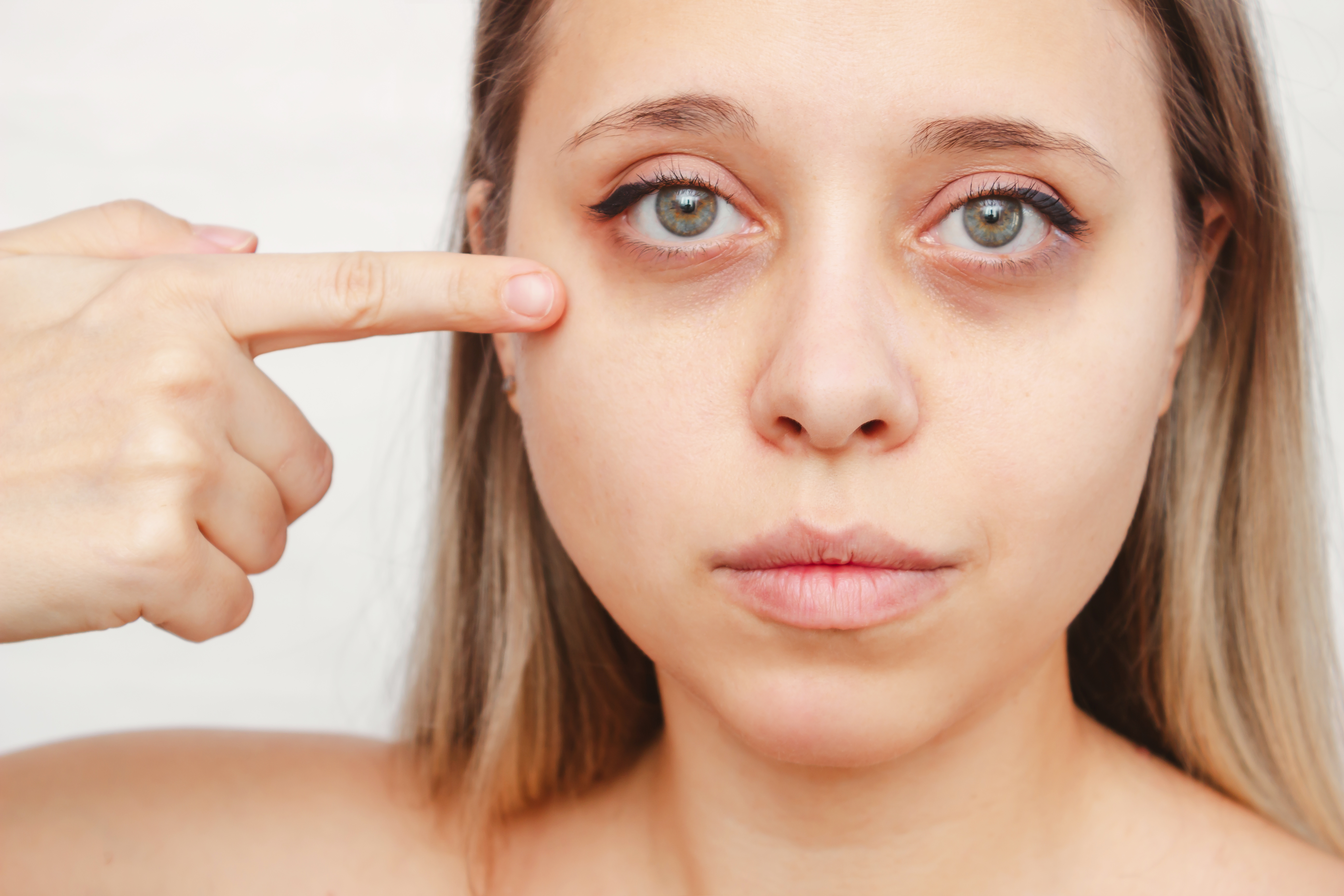 Under Eye Dark Circles